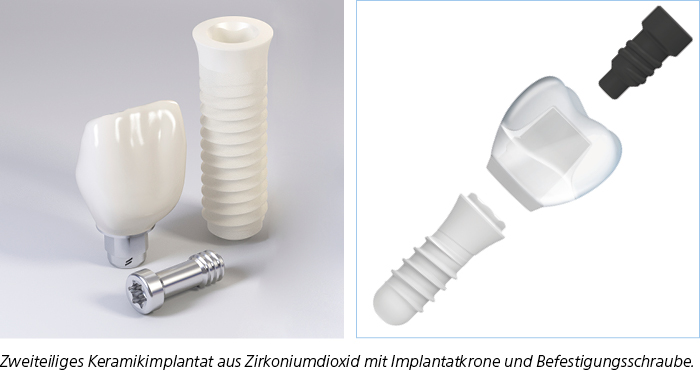 Zweiteiliges Keramikimplantat aus Zirkoniumdioxid mit Implantatkrone und Befestigungsschraube.